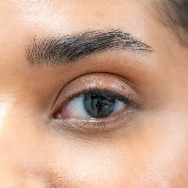 Upper Eyelid Lift